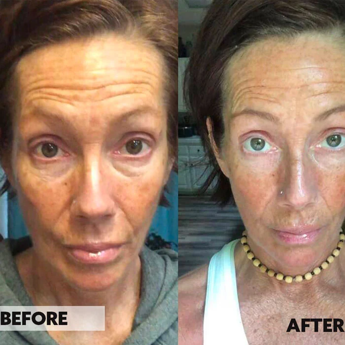 Before and after facial comparison showing reduced forehead wrinkles and improved skin texture after treatment